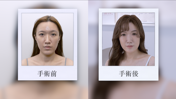 自體脂肪補臉