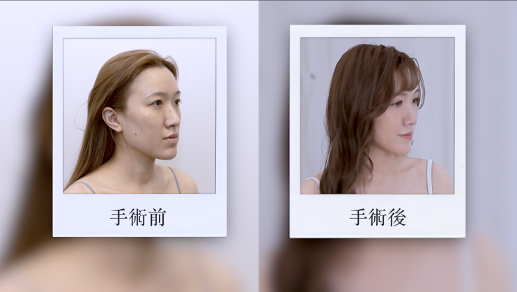 抽脂補臉