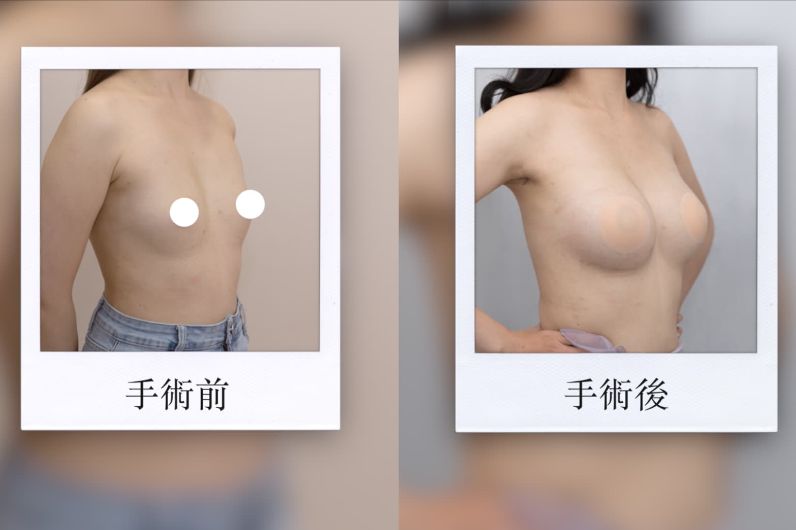 魔滴隆乳案例,胡岱霖醫師