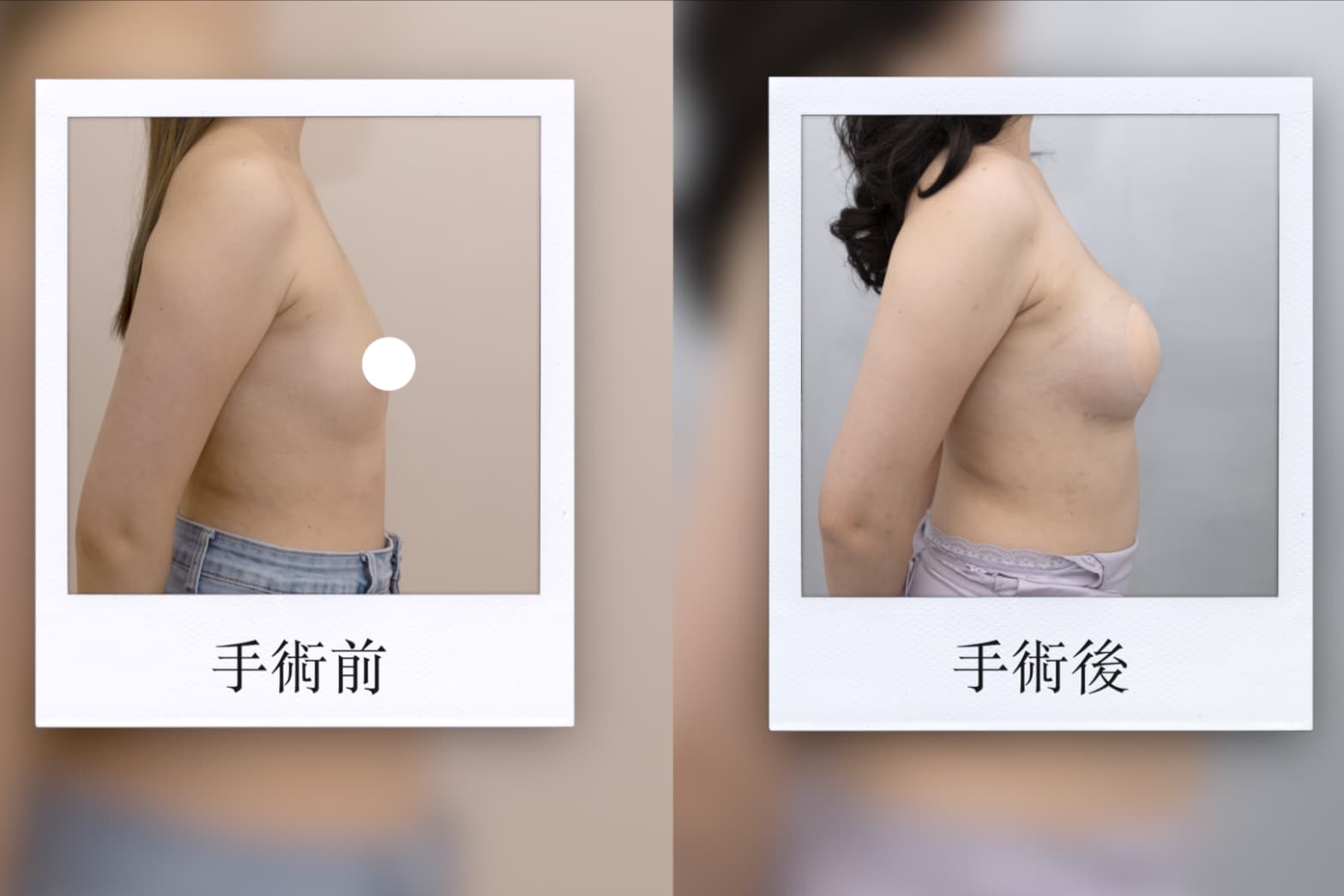 魔滴,隆乳案例