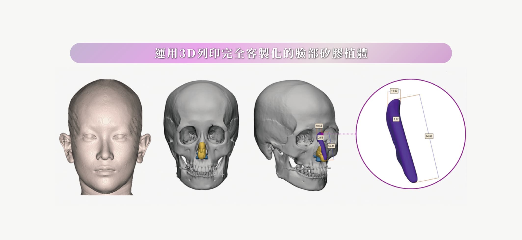 FiTme完形美3D列印植體