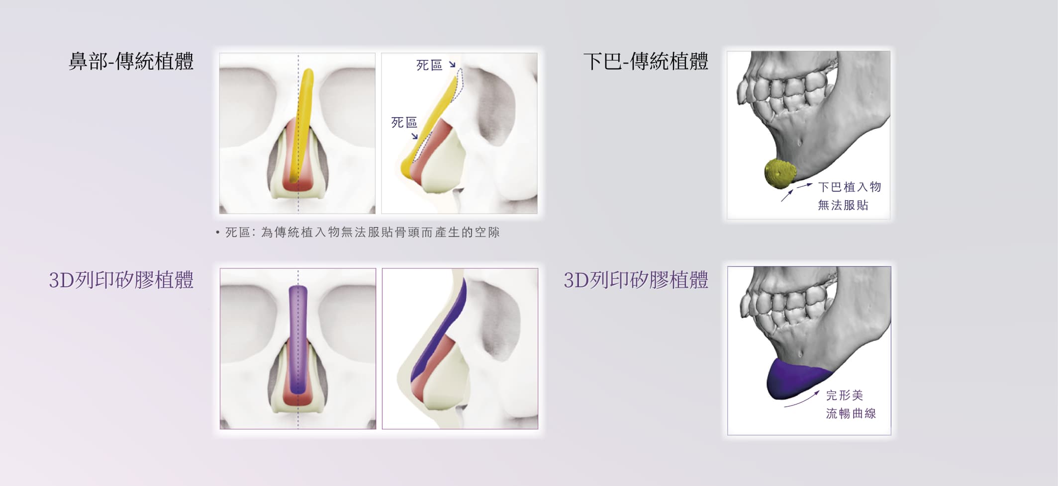 FiTme完形美3D列印植體與傳統差異