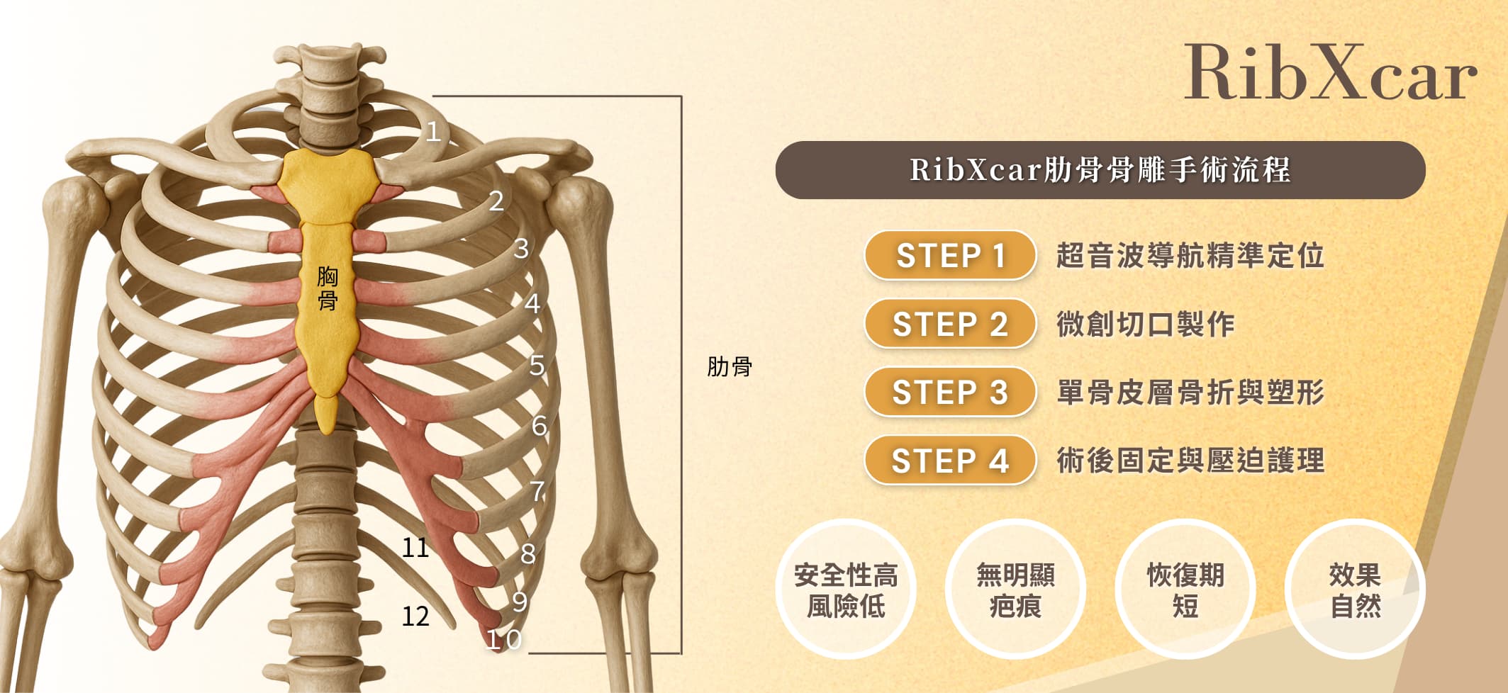 隱痕芭比腰 - RibXcar肋骨骨雕手術,隱痕芭比腰,RibXcar,肋骨骨雕手術原理流程